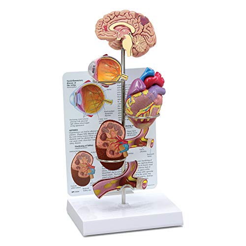 Hypertension Model Set | Human Body Anatomy Replica of The Effects from High Blood Pressure for Doctors Office Educational Tool | GPI Anatomicals