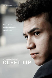 Cleft Lip