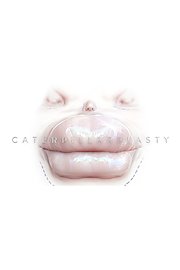 Caterpillarplasty