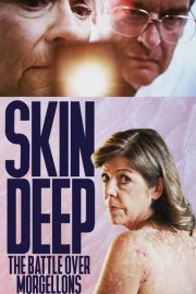 Skin Deep: The Battle Over Morgellons