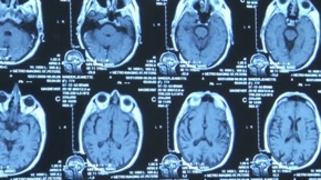 Alzheimer's Project: Momentum in Sci 1