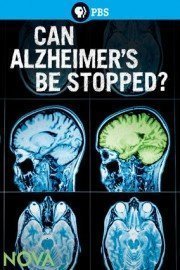Can Alzheimer's Be Stopped?